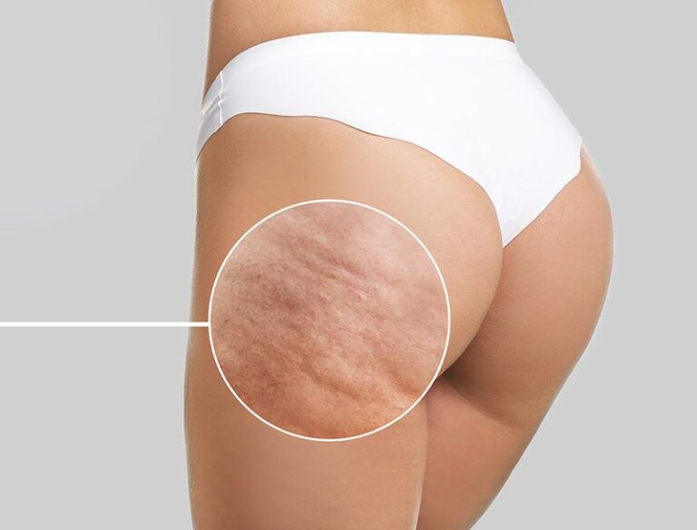 Skuteczne sposoby na trwałe pozbycie się cellulitu – odkryj metody, które działają!